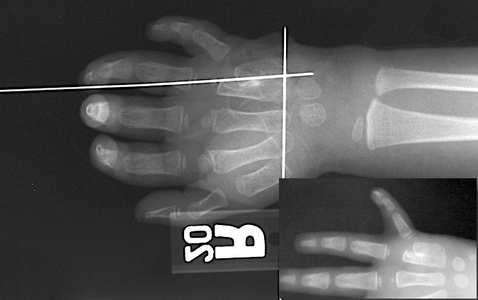 Metacarpal Synostosis Correction; K-wires on the skin to help locate the CMC joints and the synostosis.