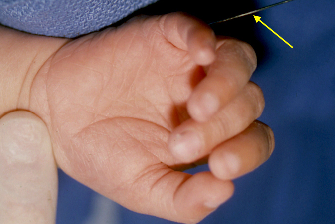 Right Metacarpal Synostosis correction with K-wire fixation (arrow).