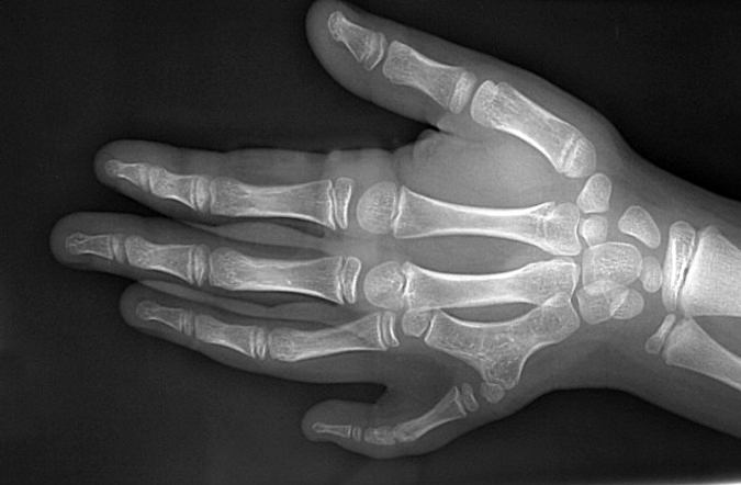 Right complex ring-little metacarpal synostosis