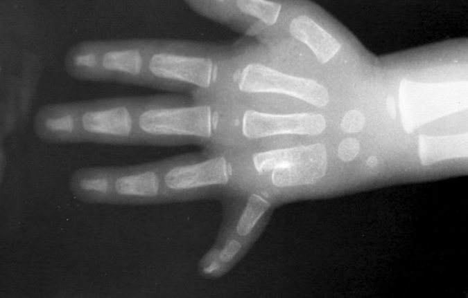 Left ring-little metacarpal synostosis