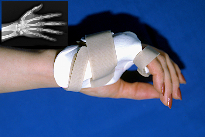 Long oblique ring metacarpal fracture treated in fracture brace