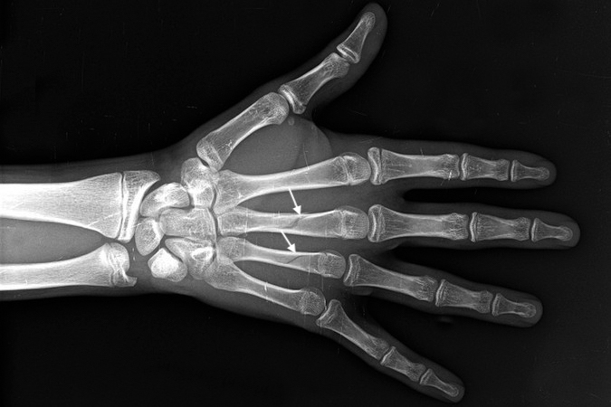 Long and ring non-displaced spiral metacarpal fractures (arrows).