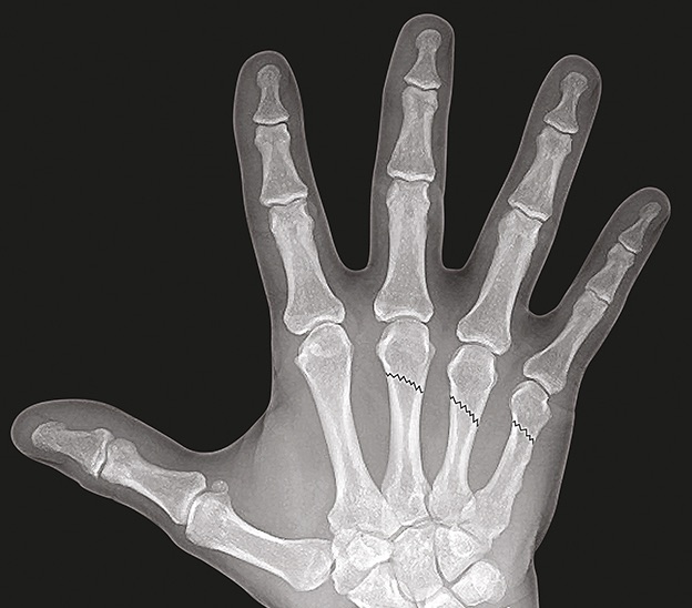 Long, Ring and Little non-displaced metacarpal head fractures (AP)