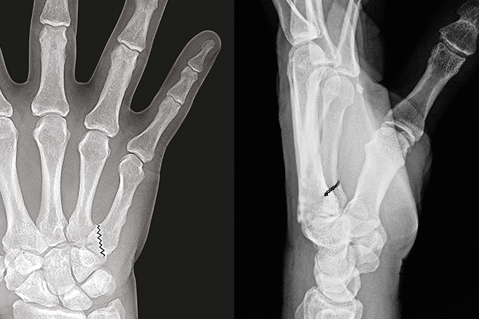 Fifth metacarpal non-displaced  base fracture (AP and Lateral)