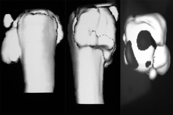Index metacarpal comminuted fracture CT reconstruction views