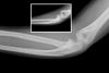 Pediatric Monteggia fracture/dislocation X-rays in a 5 year old child.