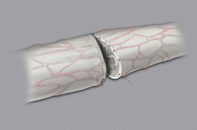  Epineural repair option for dorsal radial sensory nerve laceration