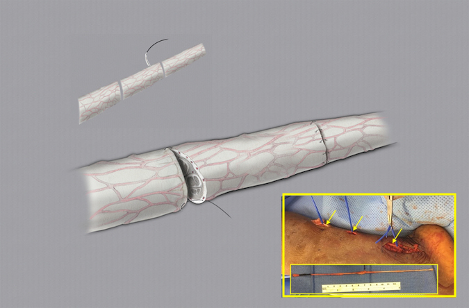 Ulnar nerve laceration with a true loss of nerve tissue repaired with a micro-surgical nerve grafting procedure using a sural nerve graft (see insert).