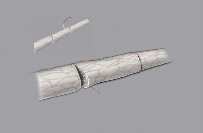 Microsurgical repair of digital nerve laceration using a nerve graft to fill a true neural defect.