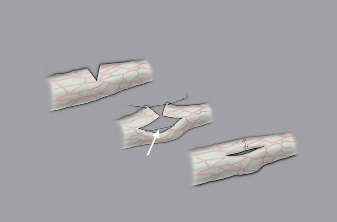 Ulnar nerve 60% partial laceration repaired by separating the intact fascicular groups from the sharply cut groups followed by fascicular group repair of the cut portion of the nerve. Tension temporarily controlled by a epineural suture in the intact fascicular groups (arrow).