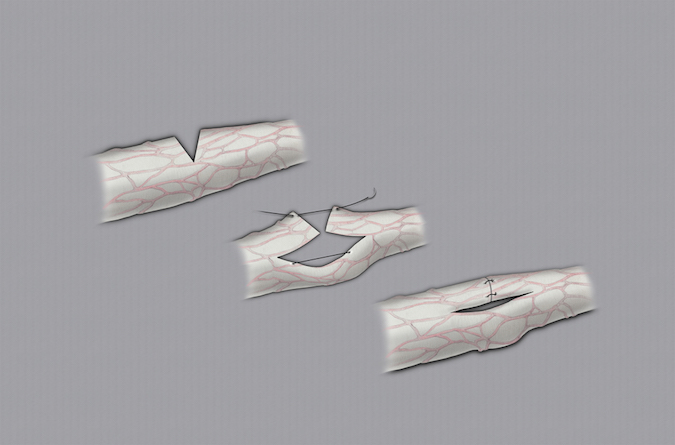 After dissecting the intact fascicular groups free, a 8-0 suture is used to temporarily control the elastic tension while cut groups are repaired.