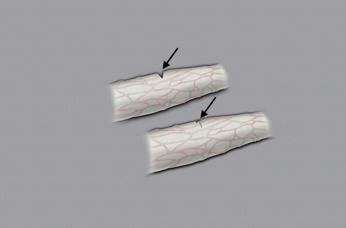 Micro-Surgical epineural repair of small partial nerve laceration.