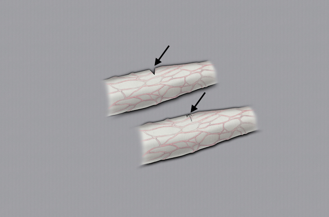 With small partial lacerations, a simple repair of the epineurium is appropriate.