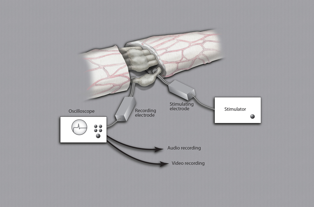 Radial nerve neuroma-in-continuity being evaluated by  intra-operative  electrophysiological testing.