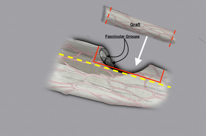 Larger ulnar nerve partial laceration with significant nerve loss. Nerve graft repair done by separating (yellow line) the intact fascicular groups from the groups with nerve loss. The damage portion of the nerve (red box) removed and graft trimmed and sutured into the gap.