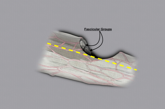 Median nerve with a partial laceration.  Note the cut fascicular groups (arrows).  The first repair step is to dissect the intact fascicular groups away from the cut groups (dotted line).