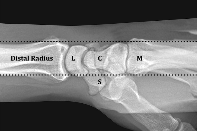 Normal distal radius(R), capitate C), lunate(L), scaphoid(S) and metacarpals(M) alignment on “true” lateral x-ray of the wrist. A “true” lateral x-ray of the wrist must be taken in neutral forearm rotation and neutral wrist deviation.