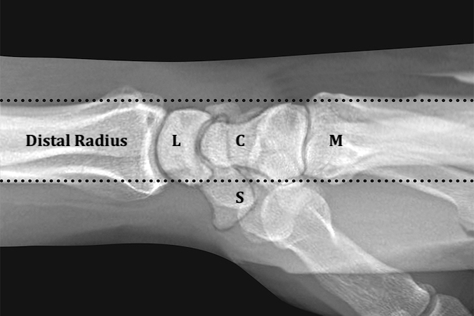 Normal distal radius(R), capitate C), lunate(L), scaphoid(S)  and metacarpals(M) alignment on “true” lateral x-ray of the wrist.  A “true” lateral x-ray of the wrist must be taken in neutral forearm rotation and neutral wrist deviation.