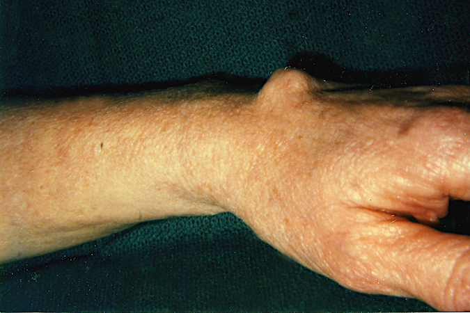 Osteochondroma originating from left wrist.  Patient thought the lump was a ganglion cyst.