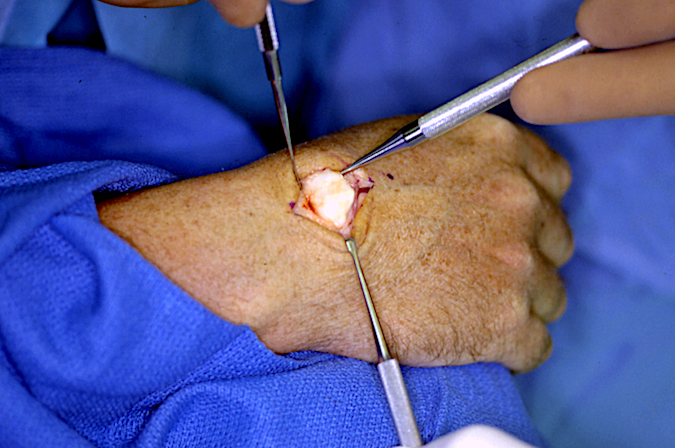 Excision of a osteochondroma originating from right wrist. Extensor tendons are retracted and an osteotomy will separate the base from the underlying carpal bone.