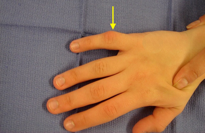 Osteochondroma originating from the right  fifth proximal phalanx neck.  Parents note decreased motion and slight deviation of the finger.