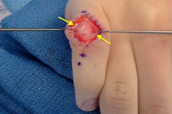Osteochondroma excised by splitting extensor tendon (arrows)