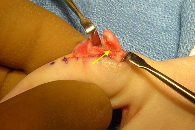 Osteochondroma osteotomy almost complete (arrow)