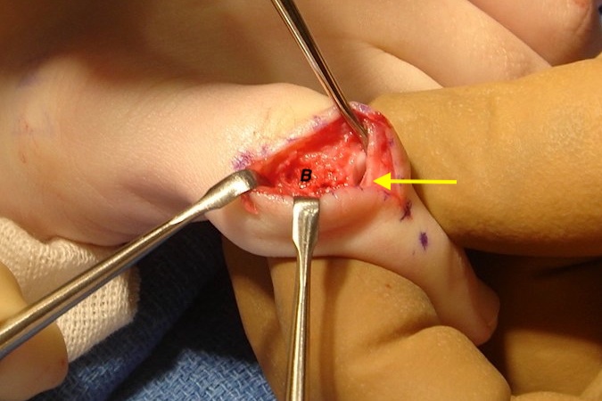 Osteochondroma osteotomy complete with base visible (B), elevator in PIP joint and central slip insertion (arrow) intact.
