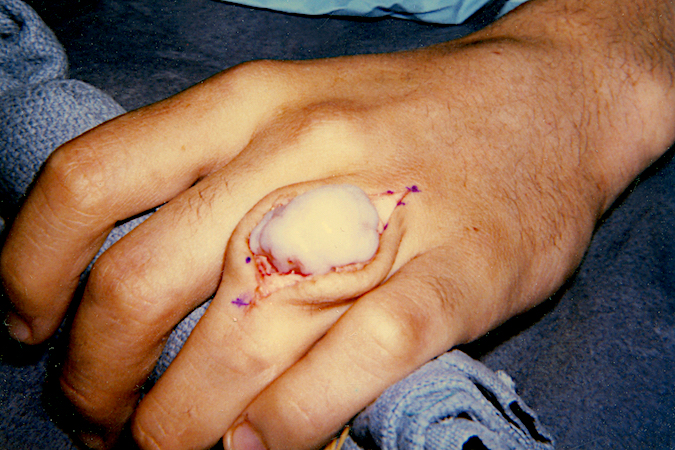 Osteochondroma originating from left ring finger proximal phalanx  After opening the skin incision the extensor tendon has been split longitudinally to expose the lesion. K-wire holes have been made to outline the base before performing an osteotomy.
