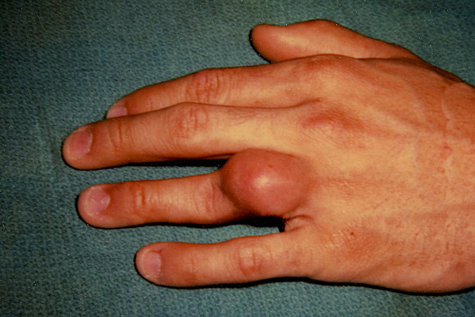 Osteochondroma originating from left ring finger proximal phalanx.  Patient complaining of  pain, decreased motion and recent enlargement of the mass.