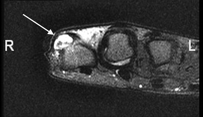 Osteochondroma MRI left little finger proximal phalanx base