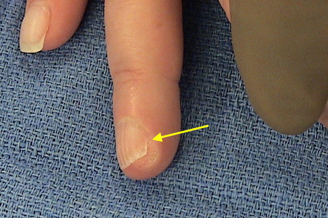 Osteochondroma originating from the right ring distal phalanx with nail deformity.
