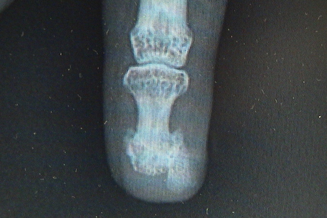 Turret Osteochondroma X-ray originating from right distal phalanx