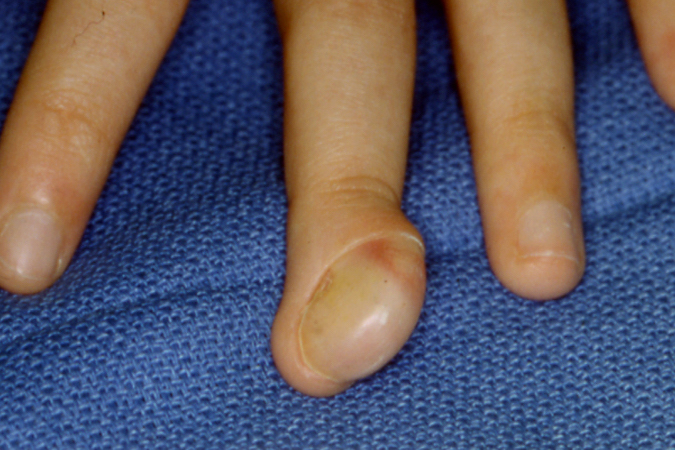 Osteochondroma originating from the left long distal phalanx with marked nail deformity and some pain.