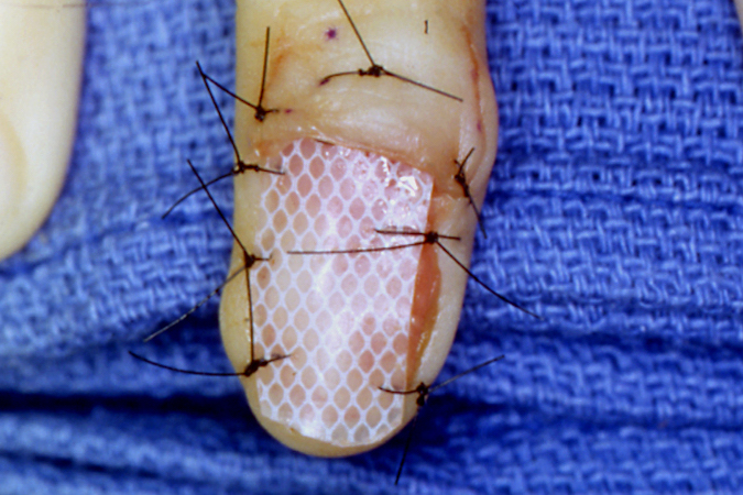 Closure and nail bed reconstruction after excision of Turret Osteochondroma