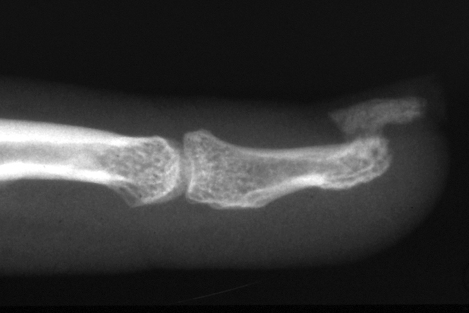 Osteochondroma (Turrett Type) distal phalanx  X-ray. Looks like a gun turrett on a battle ship.