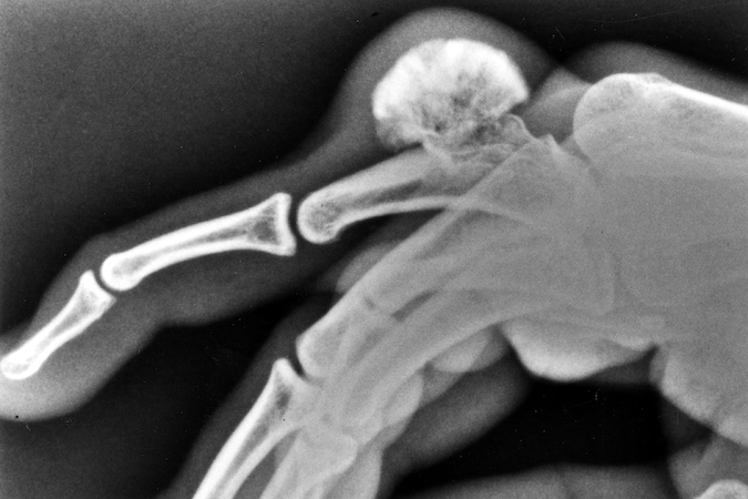 Osteochondroma left right finger proximal phalanx  X-ray. Suggestive of a sun burst appearance but this is not a osteogenic sarcoma.