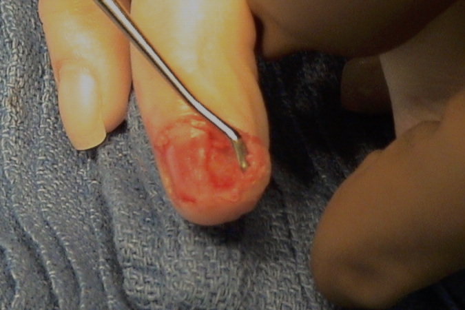Turret Osteochondroma being dissected off the distal phalanx after nail plate removal.