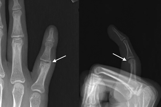 Skeletally mature teenager presents with painful, swollen PIP with decreased ROM after condylar fracture of P1 was allowed to healed in a displaced position (arrow). A P1 osteoplasty was recommended.