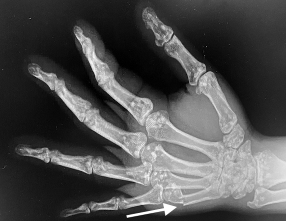 Osteopoikilosis right hand oblique X-ray with a Boxer's fracture (arrow)