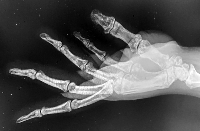 Osteopoikilosis right hand lateral X-ray with a Boxer's fracture (arrow)