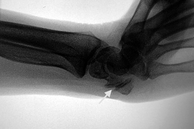 OSTEOARTHRITIS, PISOTRIQUETRAL | Hand Surgery Resource