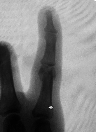 Proximal phalanx fracture bicondylar AP