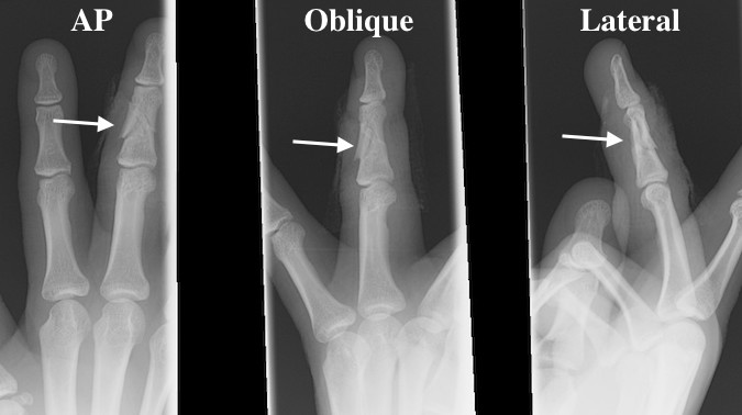 Comminuted minimally displaced closed right long finger middle phalanx fracture