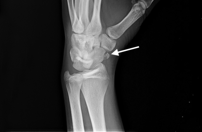 Teenager with scaphoid tuberosity fracture (arrow)