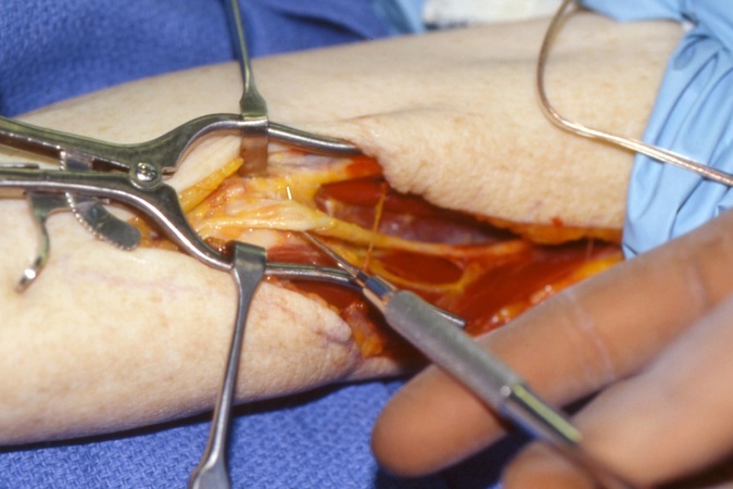 The radial tunnel has been completely open.  Note the deep head of the supinator behind the PIN and the branches of the PIN at the tip of the probe.