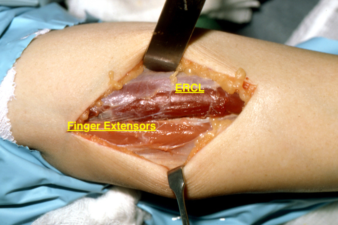 Posterior approach to the PIN. Note healthy ECRL innervated proximal to the PIN and pale finger extensor muscles distal to the entrapment.  Muscle biopsy of EDC showed early denervation atrophy.