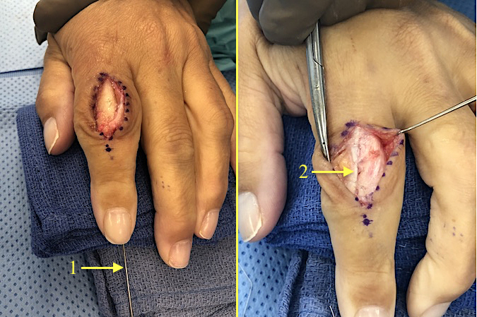 Index PIP joint fusion in mild flexion with K-wire (1).  Residual cartilage has been removed and head of P1 fitted into base of P2;  Note sutured capsule and extensor tendontomy (2).