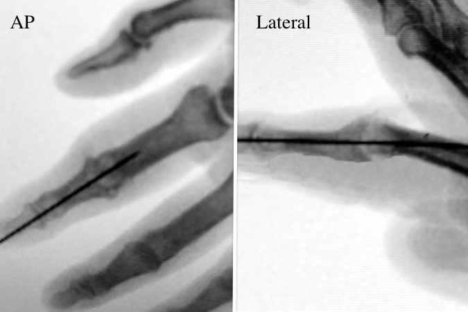 X-ray of index PIP joint fusion in mild flexion.  K-wire in place.