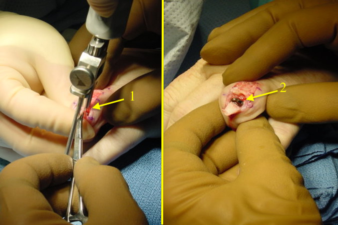 Awl opening P2 (1);  Prosthesis in P2 (2).